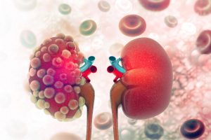 kidney-disease-in-3d-render